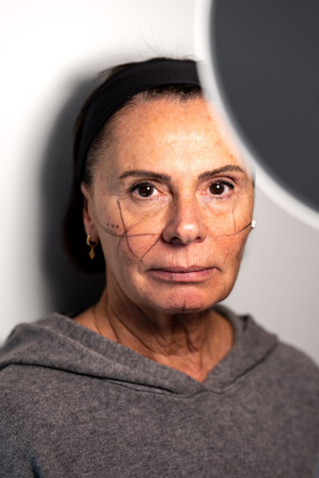 Ritratto di Signora Sottoposta a Visita di Medicina Estetica sotto una Lampada, Segni Fatti con il Gesso nel Viso.