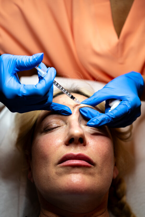Precisione Estetica: Dettaglio di Siringa Utilizzata per un Trattamento Botox, Rappresentando Attenta Competenza nella Medicina Estetica