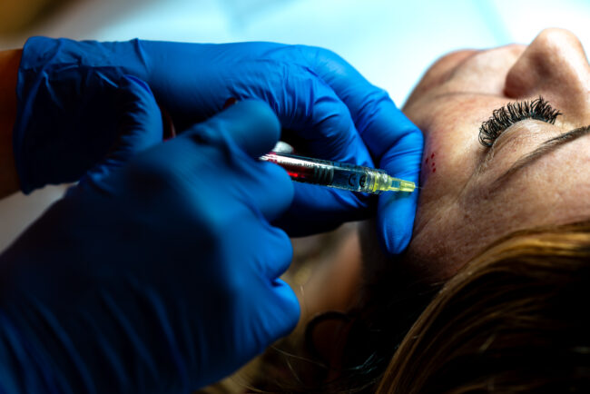 Precisione Estetica: Dettaglio di Siringa Utilizzata per un Trattamento Botox, Rappresentando Attenta Competenza nella Medicina Estetica